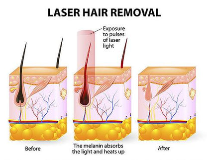 Velnor® IPL Hair Removal Device — At-Home Permanent Hair Removal | Pain-Free